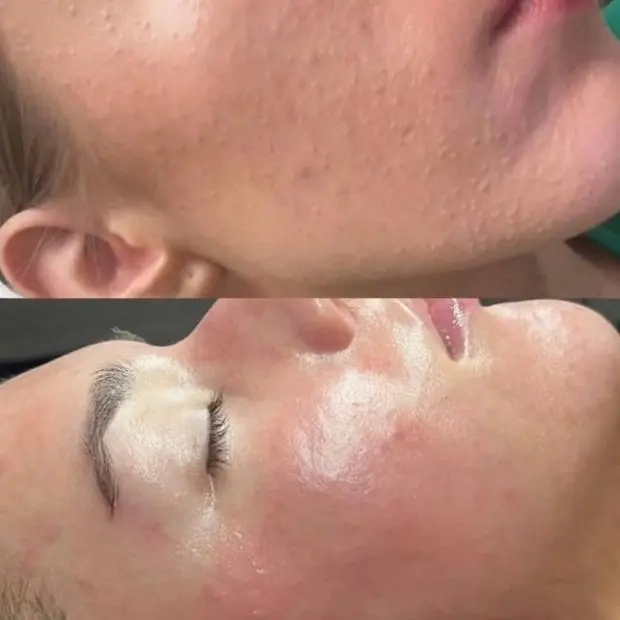 Acne healing care treatment