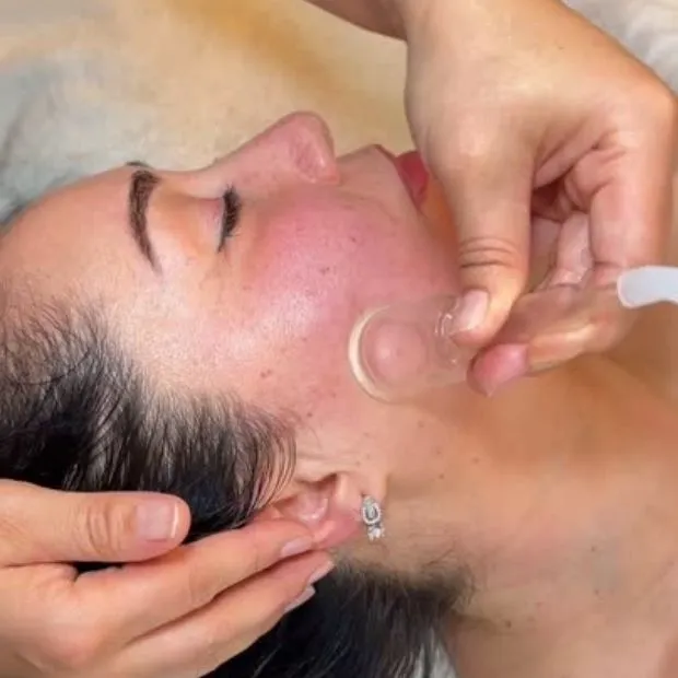 Radio frequency skin tightening treatment