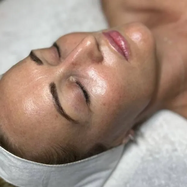 Skin peeling after chemical peel treatment
