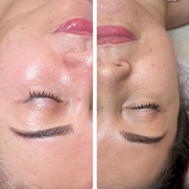 Brightening Facial before and after — improved tone and glow